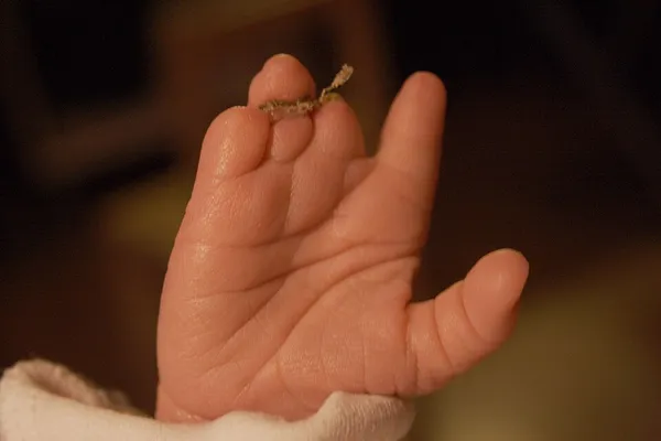 Congenital amputation