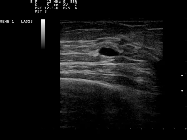 Breast cyst