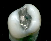 Dental amalgam controversy