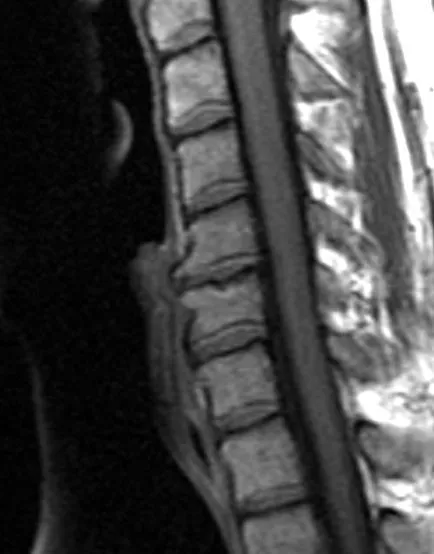 Degenerative disc disease