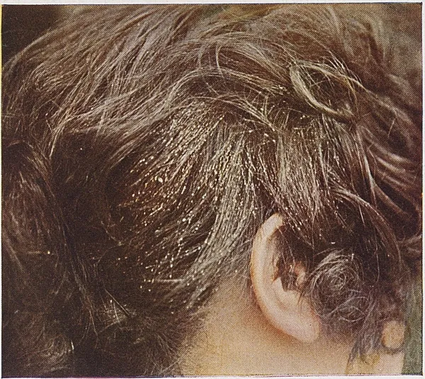Head lice infestation