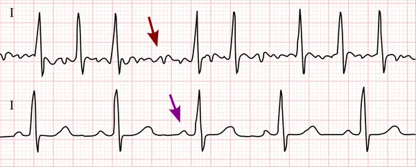 Atrial fibrillation