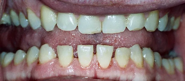 Acromegaly