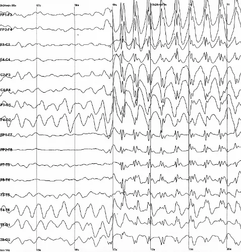 Electroencephalography