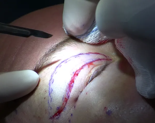 Blepharoplasty
