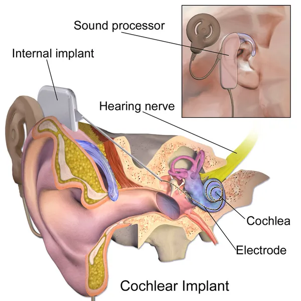 Cochlear implant