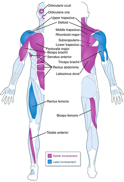 Facioscapulohumeral muscular dystrophy