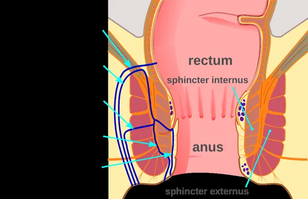 Anal fistula