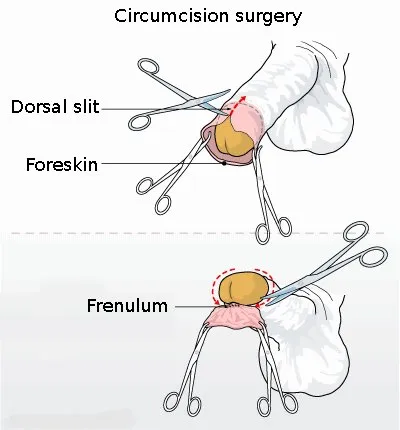 Circumcision surgical procedure