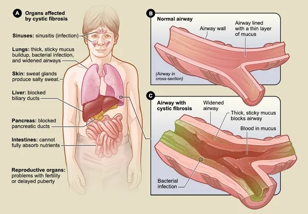 Cystic fibrosis