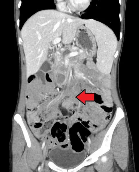 Aggressive fibromatosis