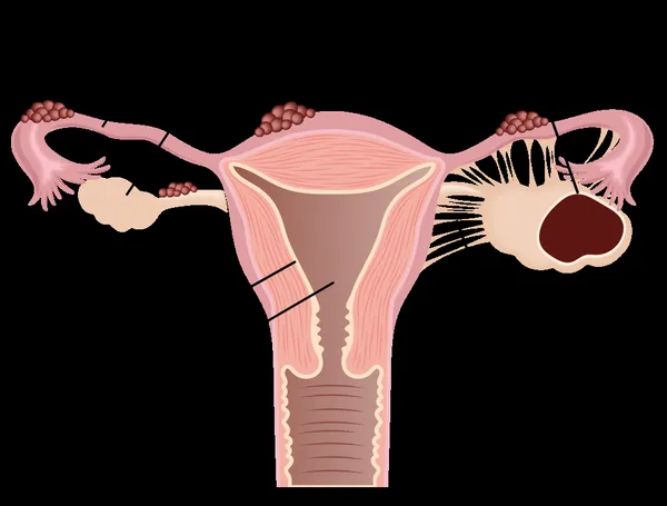 Endometriosis