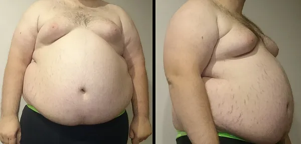 Abdominal obesity