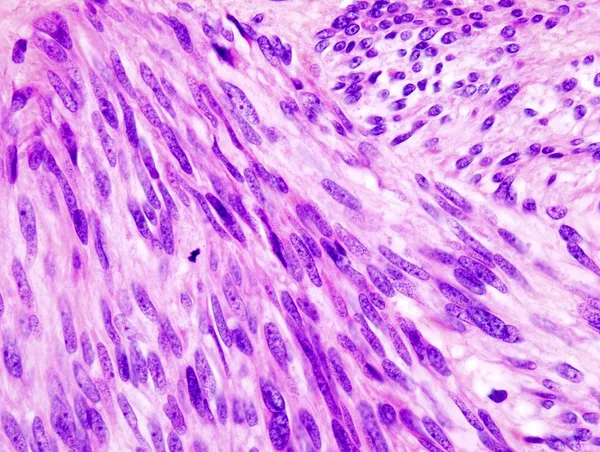 Gastrointestinal stromal tumor