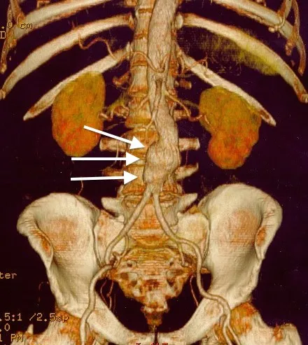 Abdominal aortic aneurysm