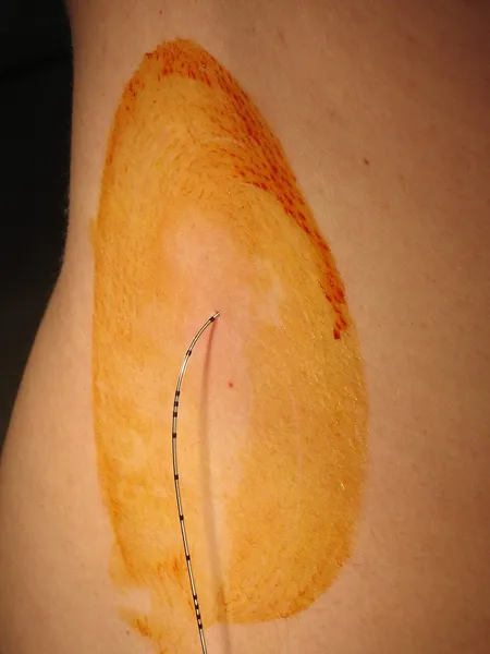 Epidural administration